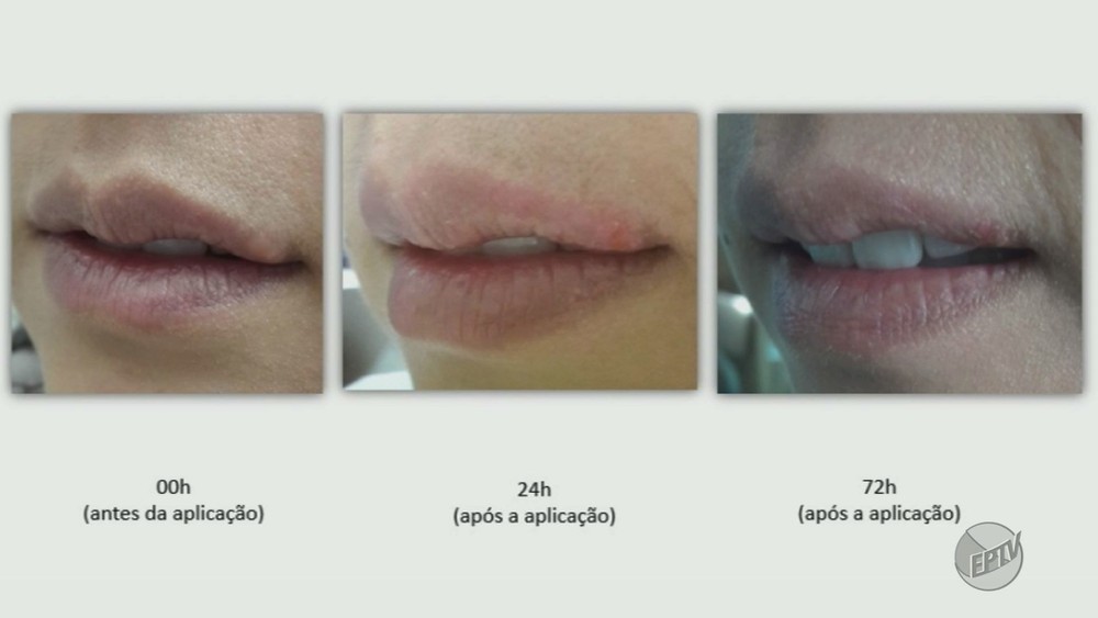 Leia mais sobre o artigo USP desenvolve pomada que promete secar feridas de herpes em até dois dias