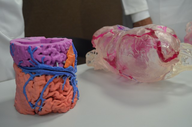 Leia mais sobre o artigo Impressão 3D, ‘GPS do cérebro’: separação de siamesas unidas pela cabeça incentiva avanços médicos