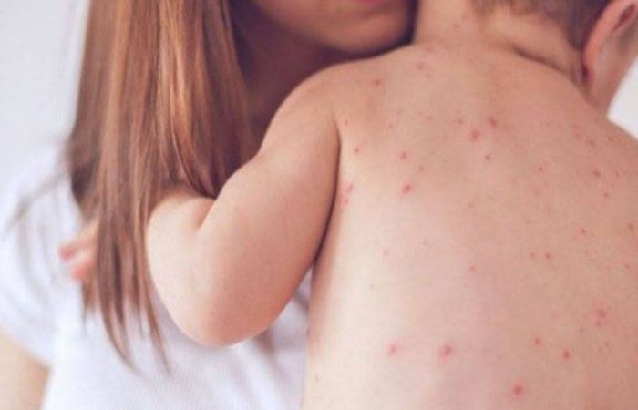 Leia mais sobre o artigo Brasil tem 2.192 casos de sarampo confirmados