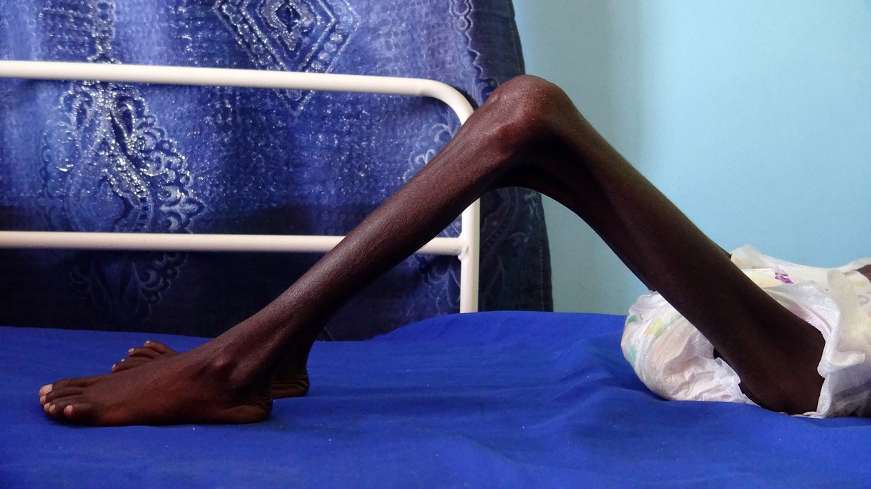 Leia mais sobre o artigo Fome extrema atinge mais de 113 milhões no mundo, diz relatório da ONU