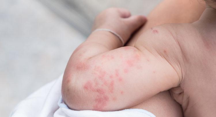 Leia mais sobre o artigo Nordeste é a região que mais desconhece a Urticária Crônica Espontânea