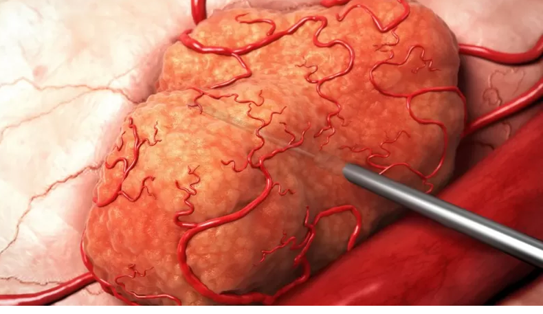 Leia mais sobre o artigo Nova radioterapia é promissora contra tumores preservando tecido saudável; entenda